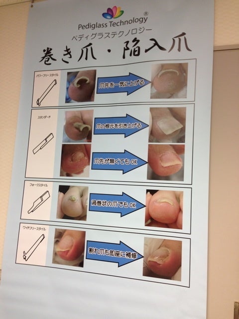 巻き爪補正ペディグラス | kunstylenailroomオーナー竹田ブログ