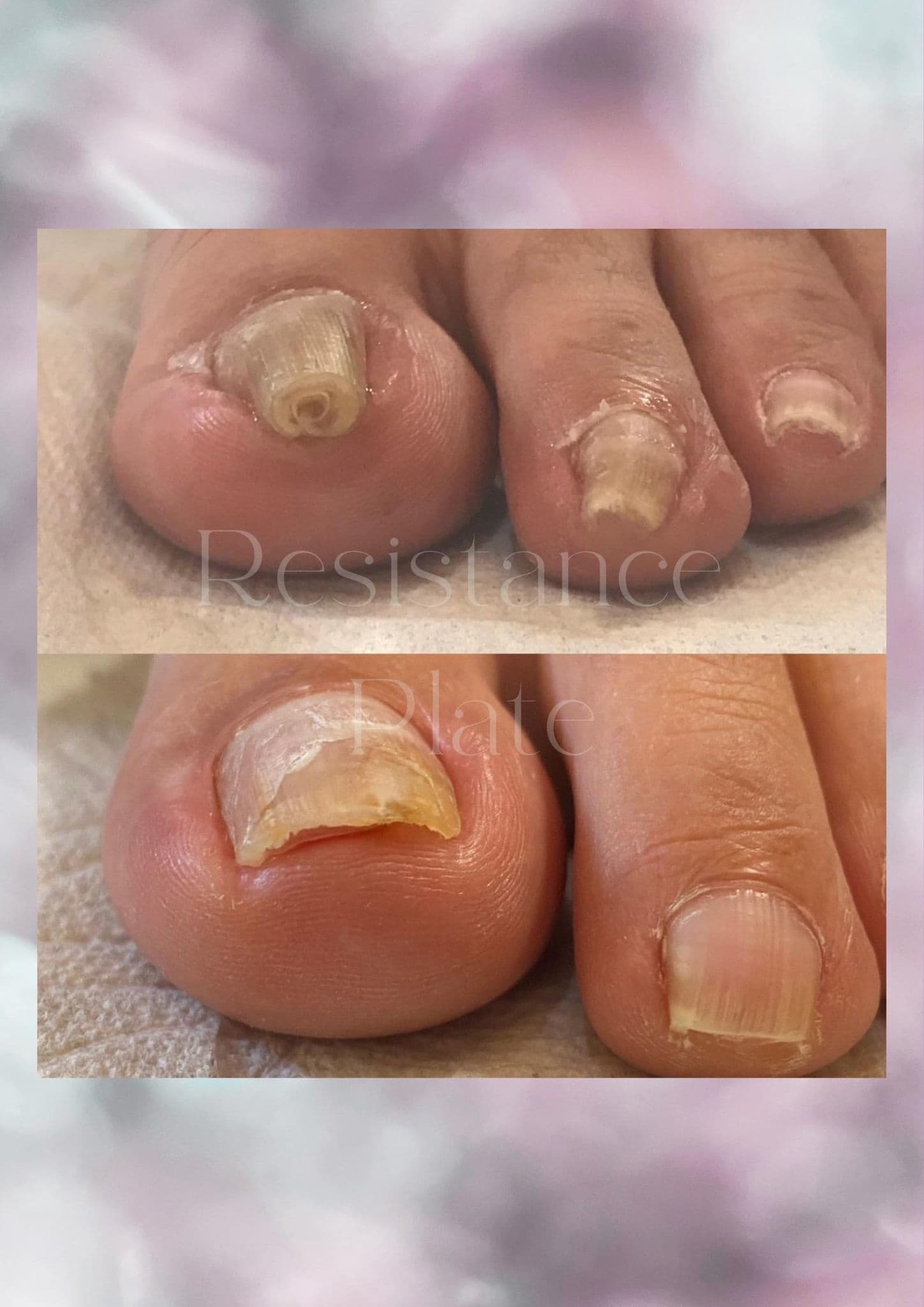 レジスタンスプレート【巻き爪解放】申込フォーム of TOKYO NAIL+COLLEGE