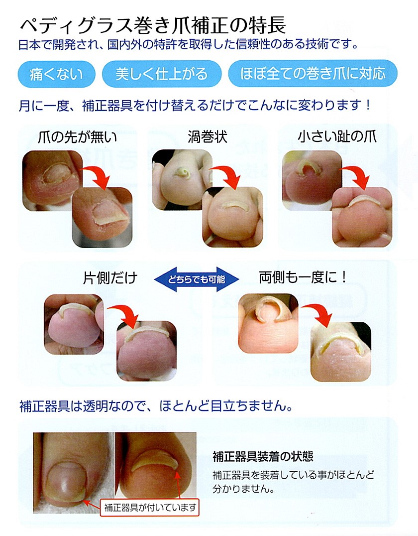 巻き爪補正セミナー【ペディグラス資格取得】 | 大田区西蒲田 たか整骨院