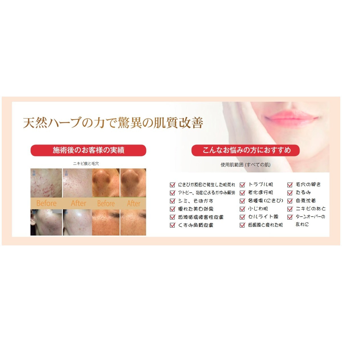 アマロス O.H.L ハーブピーリング フルセット（アマローラー付き）の卸