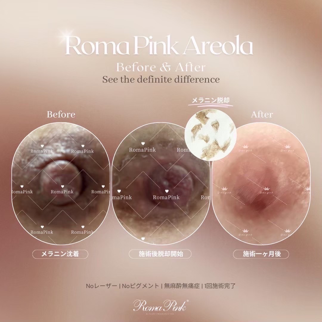 ローマピンク（Roma Pink）｜美容皮膚科エルムクリニック