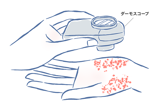 掌蹠膿疱症で行われる検査とは？｜掌蹠膿疱症を知ろう｜掌蹠膿疱症ネット
