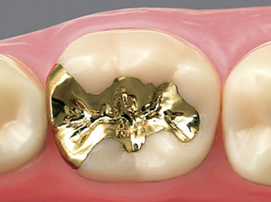 治療費・保証｜審美歯科 オールセラミック つめ物｜君津の那須歯科医院