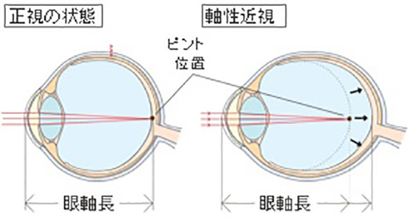 マイオピン | 関本眼科医院 芳賀郡市貝町市塙 市塙駅 眼科