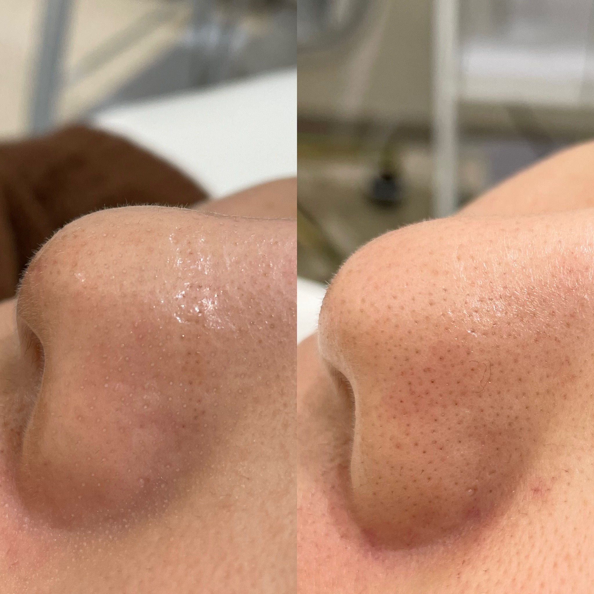 大阪・心斎橋】毛穴の黒ずみ・角栓に効果抜群！高濃度水素洗浄