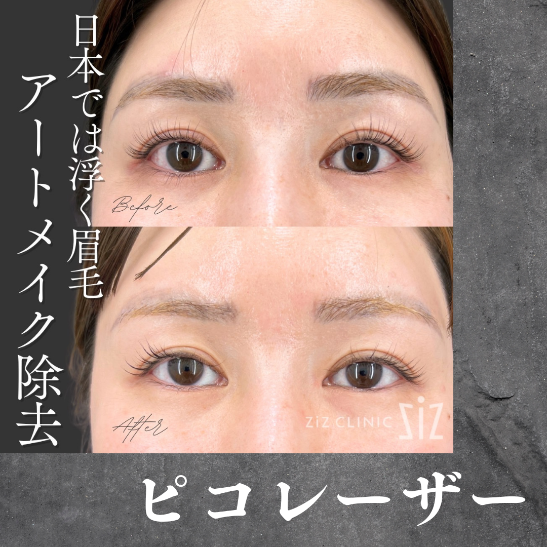 日本では浮く眉アートを消したい30代女性 - タトゥー除去専門の美容