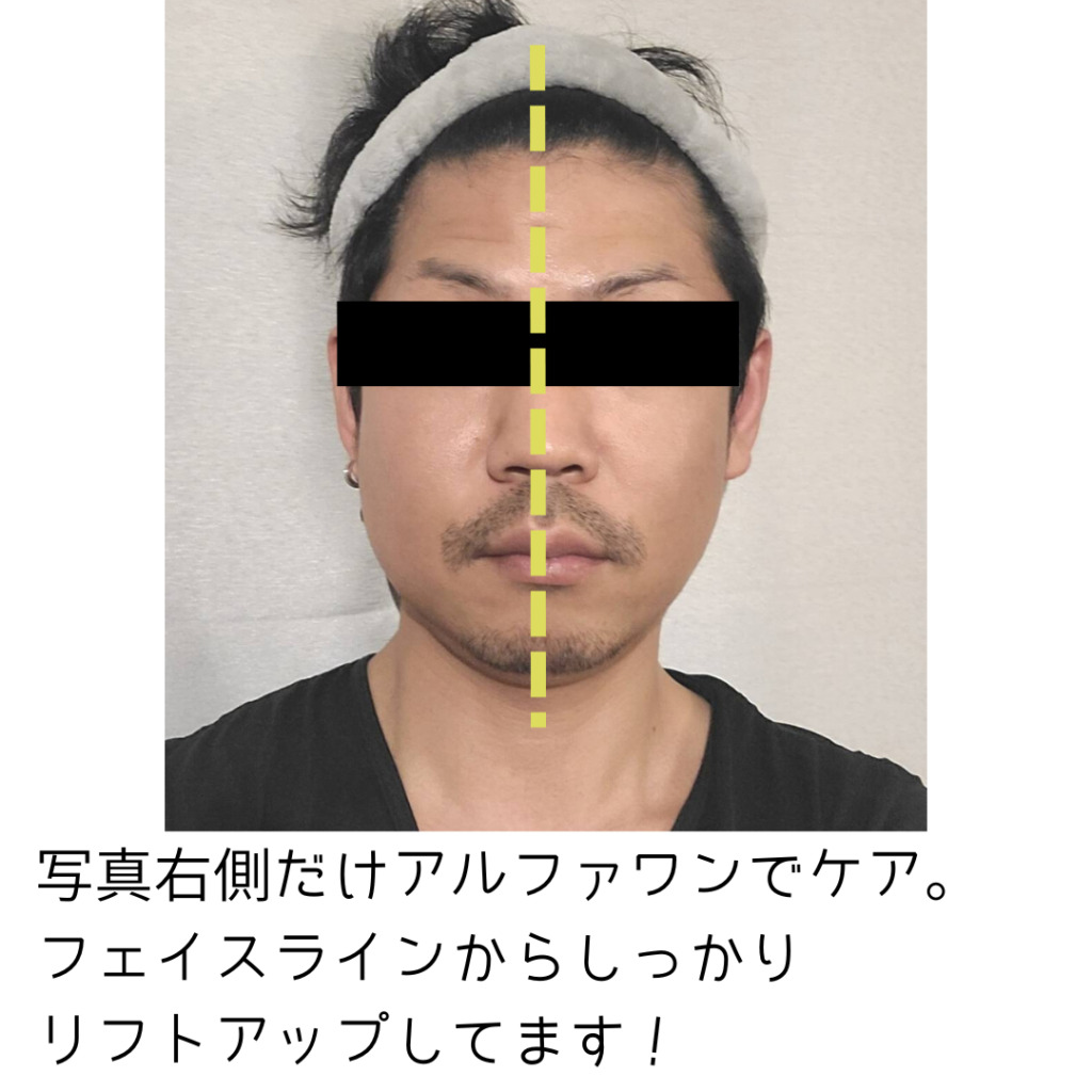 驚愕リフトアップ！ランボルギーニの最強美顔器「アルファワン」 とは