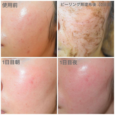 決定版】ハーブピーリングとは？効果やダウンタイムを徹底解説！ – K