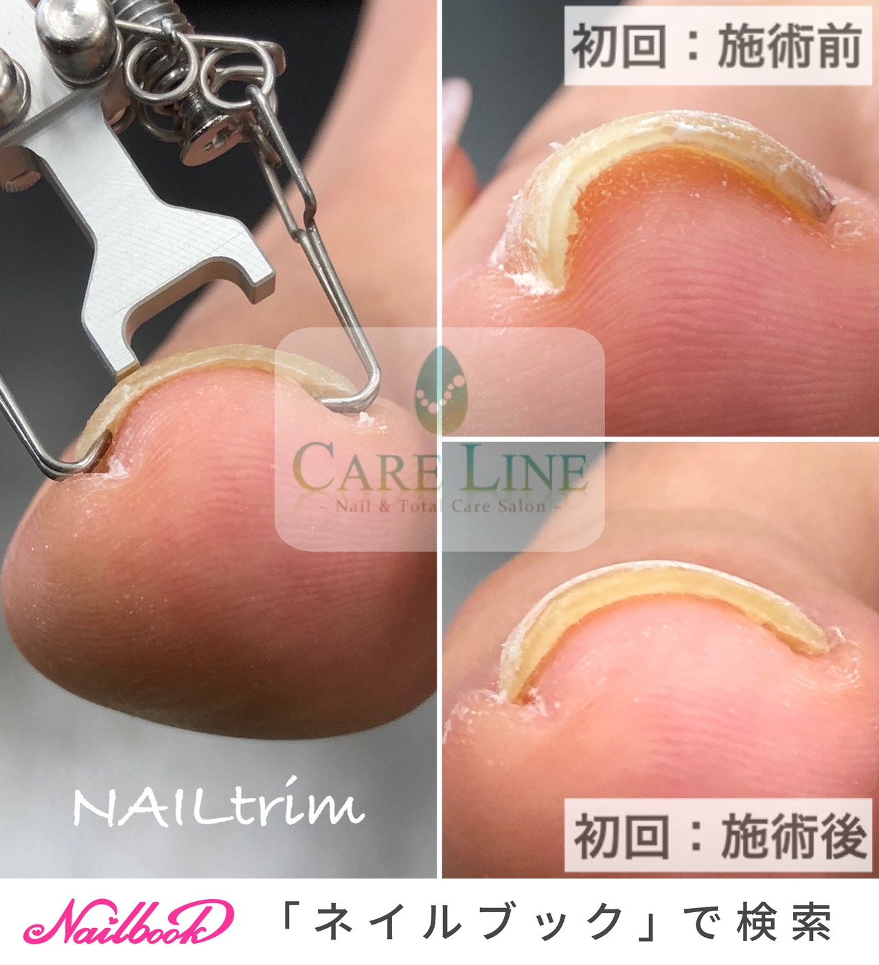 巻き爪BSブレイスクイック まとめ売り 巻き爪BSブレイスクイック