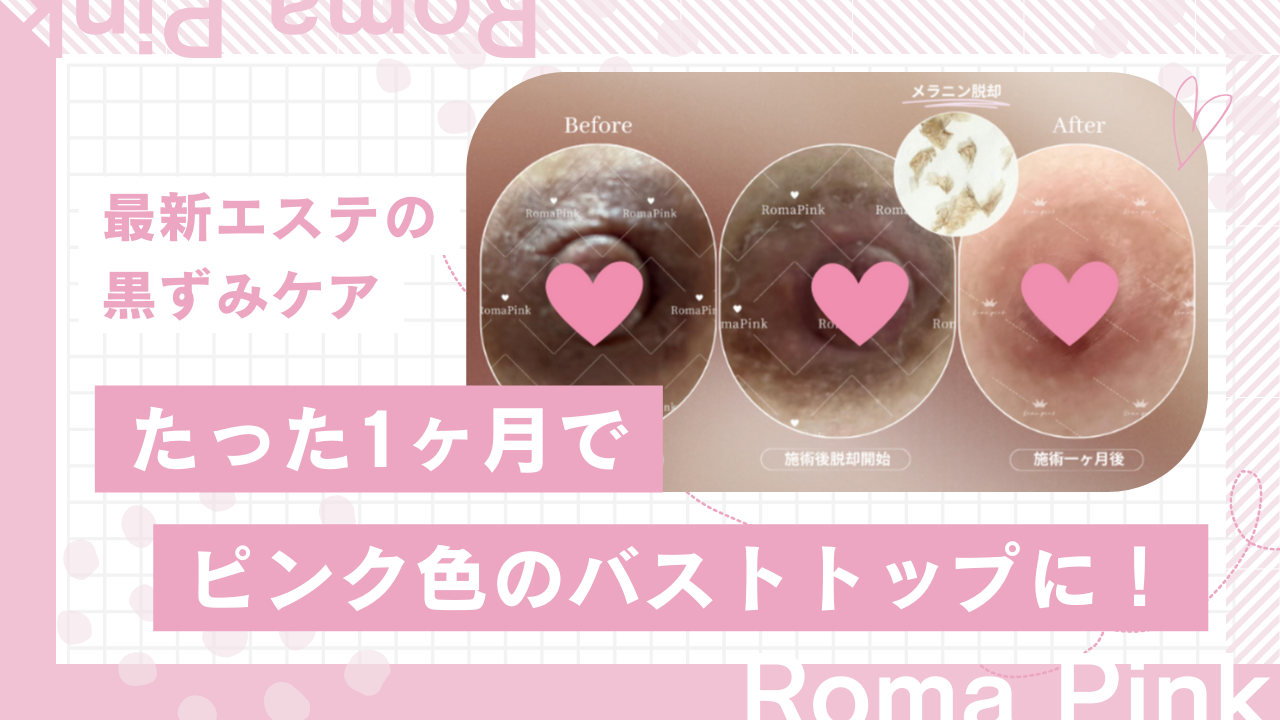 バストトップの黒ずみをピンクに！エステの最新黒ずみケアをご紹介