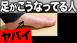 This arch is terrible! The negative effects of high arches and how