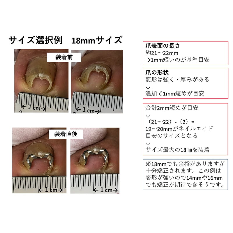ネイル・エイド ミニ 10mm 】 巻き爪矯正・巻き爪治療・ブロック