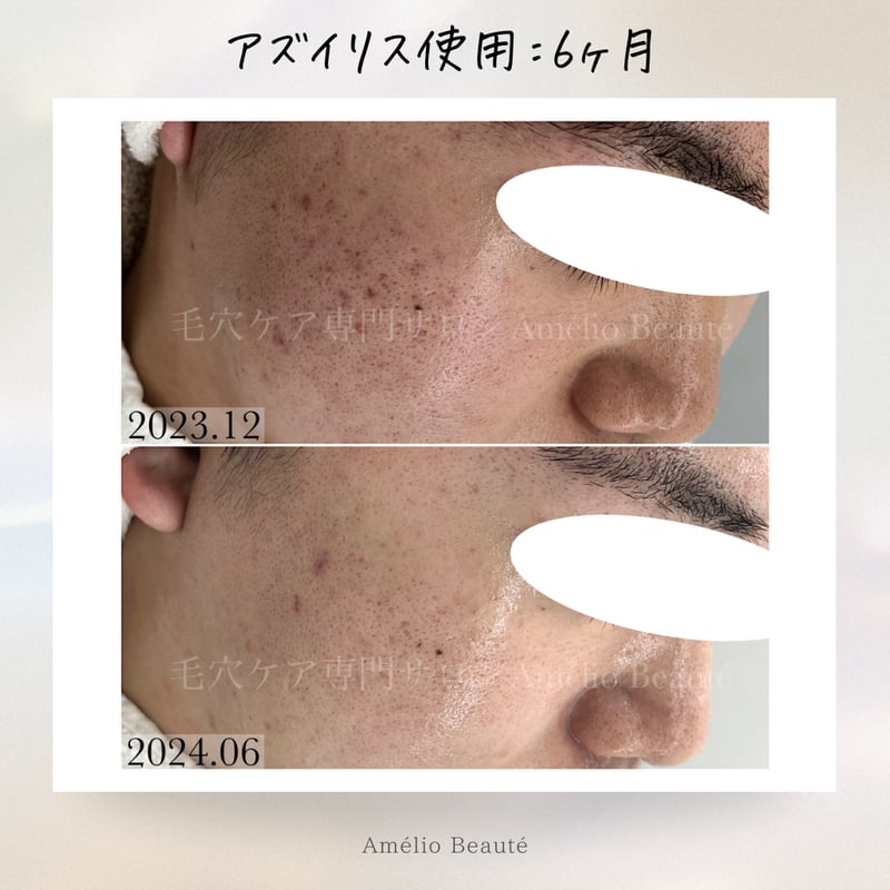 アズイリス＋アズシエル【炭酸ガスパック 肌質改善・保湿クリーム
