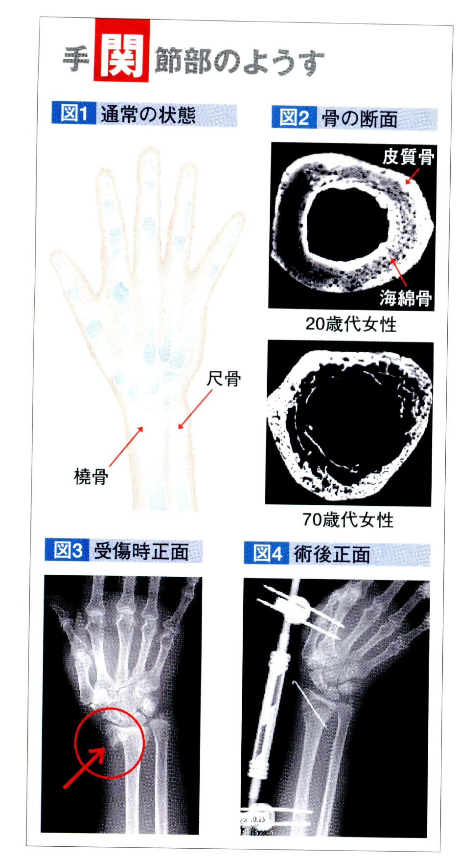 手関節部骨折 | 日本臨床整形外科学会