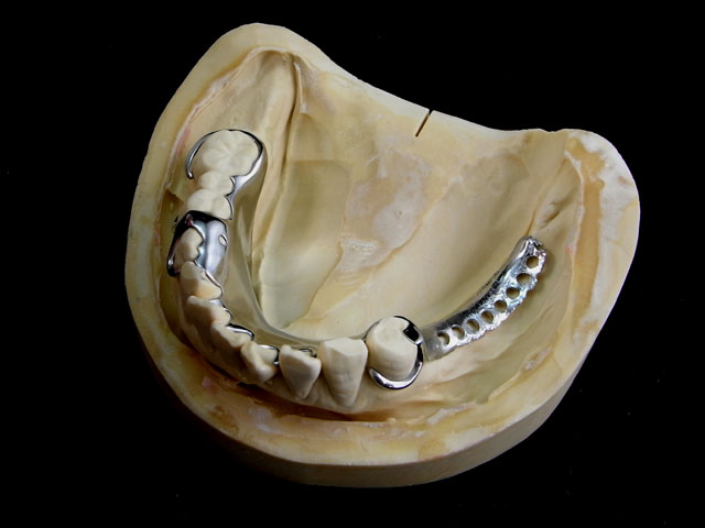 金属床|入れ歯・義歯のことなら、神奈川の歯科技工所【近藤義歯研究所】