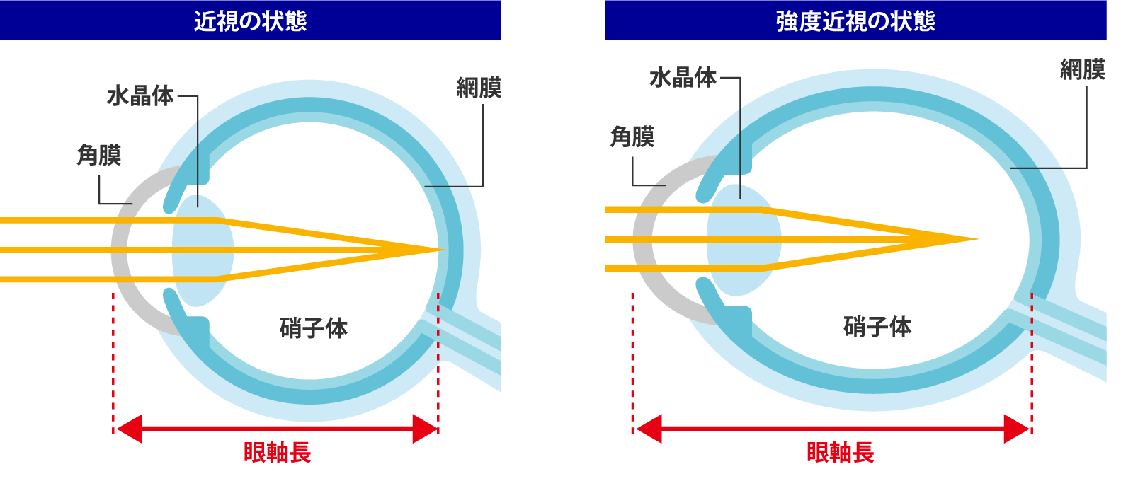 小児の近視抑制 マイオピン点眼(低濃度アトロピン点眼液) - 台東区蔵前