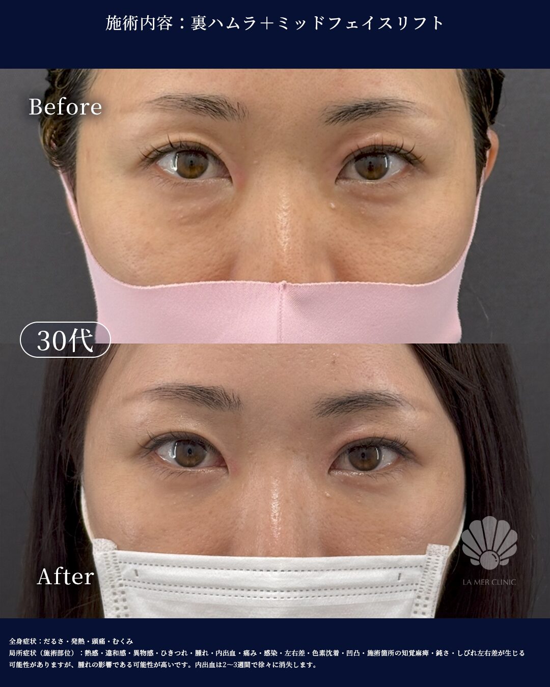 ミッドフェイスリフト（中顔面リフト） | LA MER CLINIC