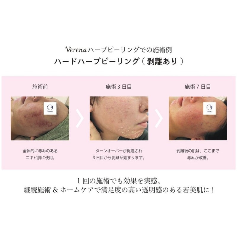 ハーブピーリングの無料セミナー（基礎理論講習）Veruna（ヴェルナ