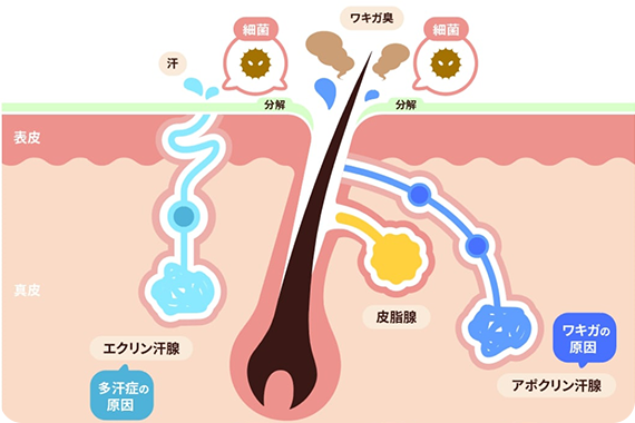 ワキガ治療・ミラドライ｜茨城県鹿嶋市松永皮フ科クリニック｜皮膚科