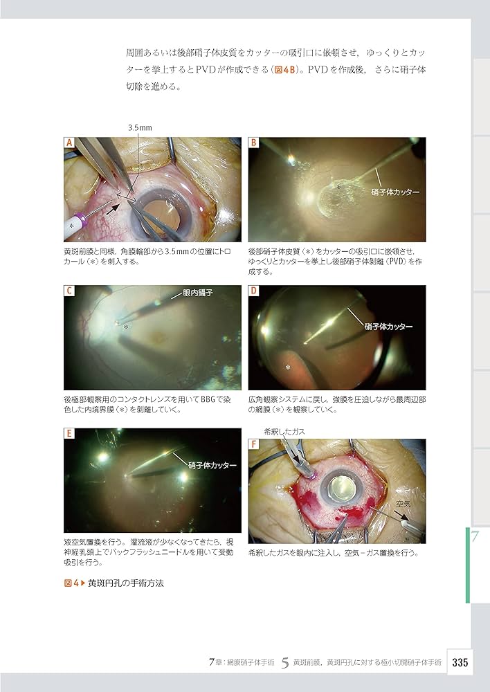 眼科レジデントのためのベーシック手術 ─ 電子版付 ─ | 谷戸正樹 |本