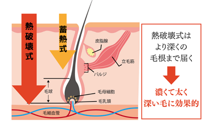医療脱毛 | 習志野市のみんなの皮ふ科・形成外科 津田沼