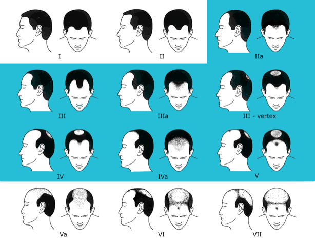 男性の薄毛治療｜ナチュラルAGAクリニック