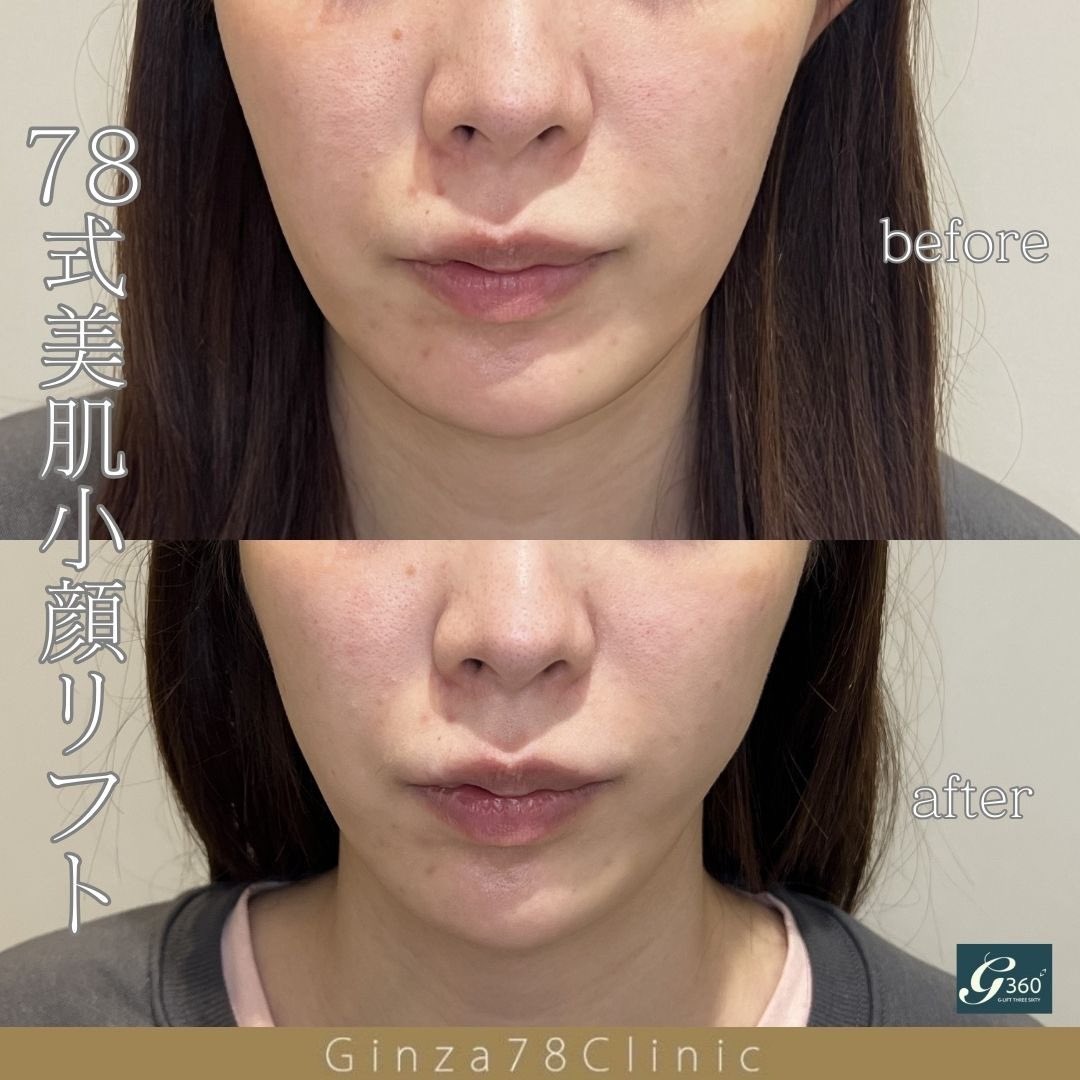 執刀医】田中医師 【内容/価格】 PDO2本/1本¥16,000 G-lift flex4本/1