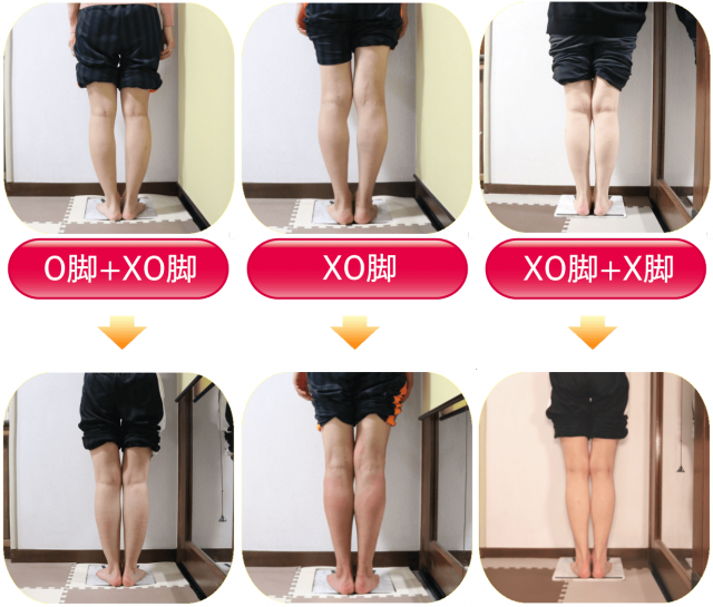 XO脚（膝下O脚）矯正 | 新宿・笹塚のO脚、骨盤矯正「めぐみ整骨院」
