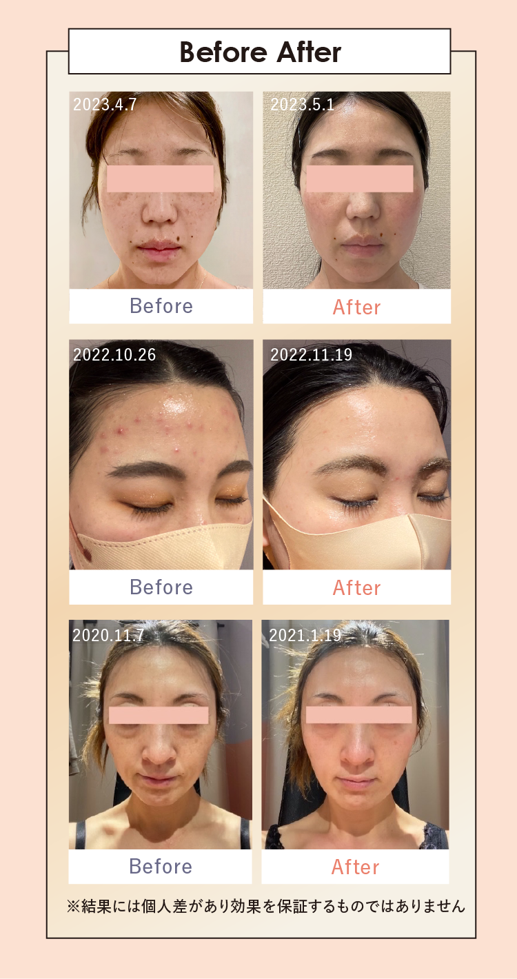 ボディアーキ ベビースキン プラン」誕生 | 【公式】定額制セルフ