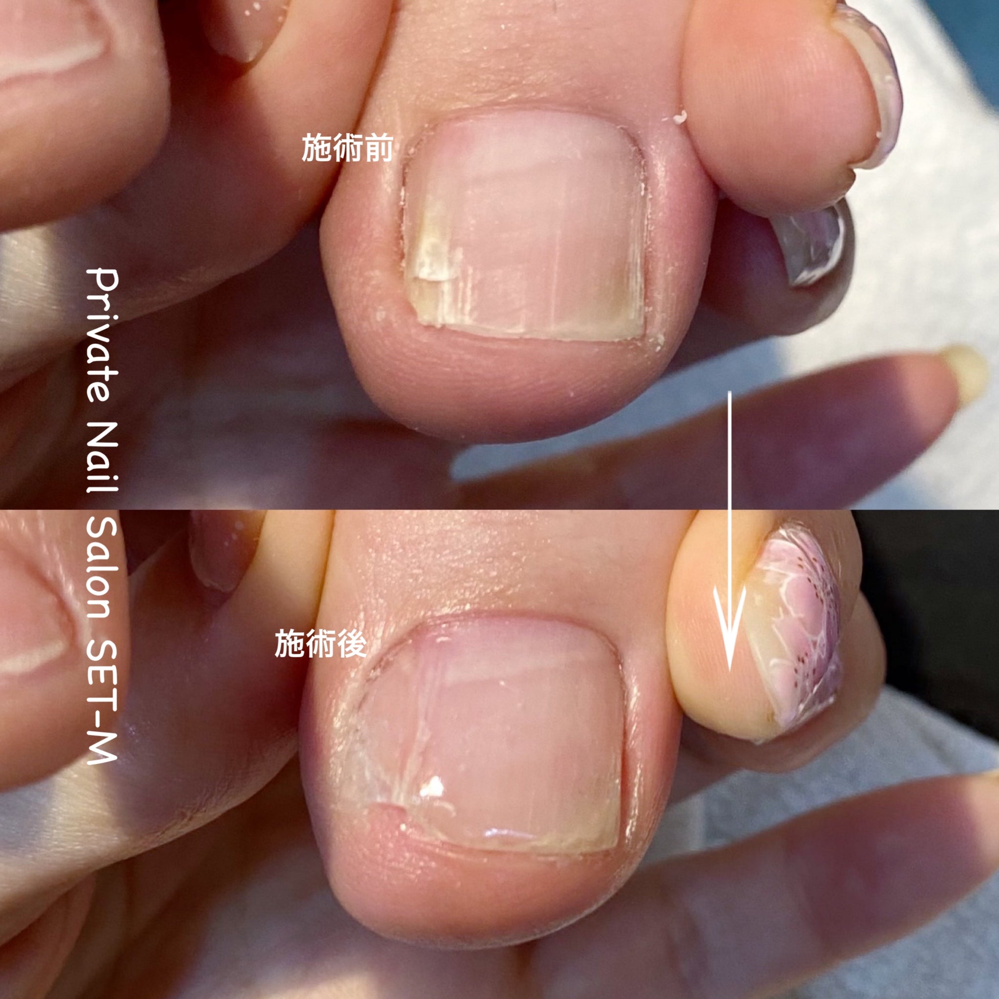 痛くない見た目も綺麗な巻き爪補正 ペディグラス | つくば市