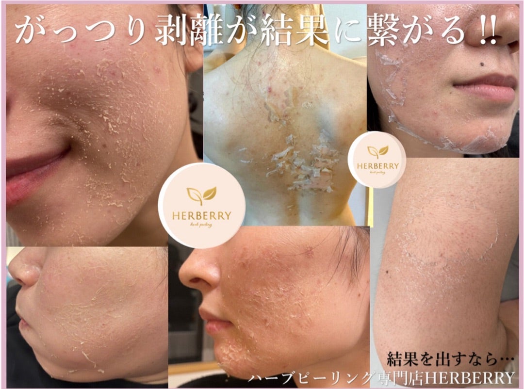剥離ありハーブピーリング、翌日から化粧可能です◎ | ハーブ