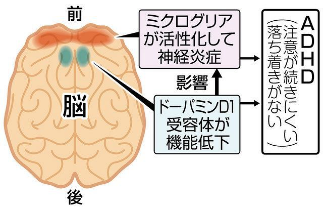 発達障害ADHDの原因 脳受容体と炎症が関係：中日新聞しずおかWeb