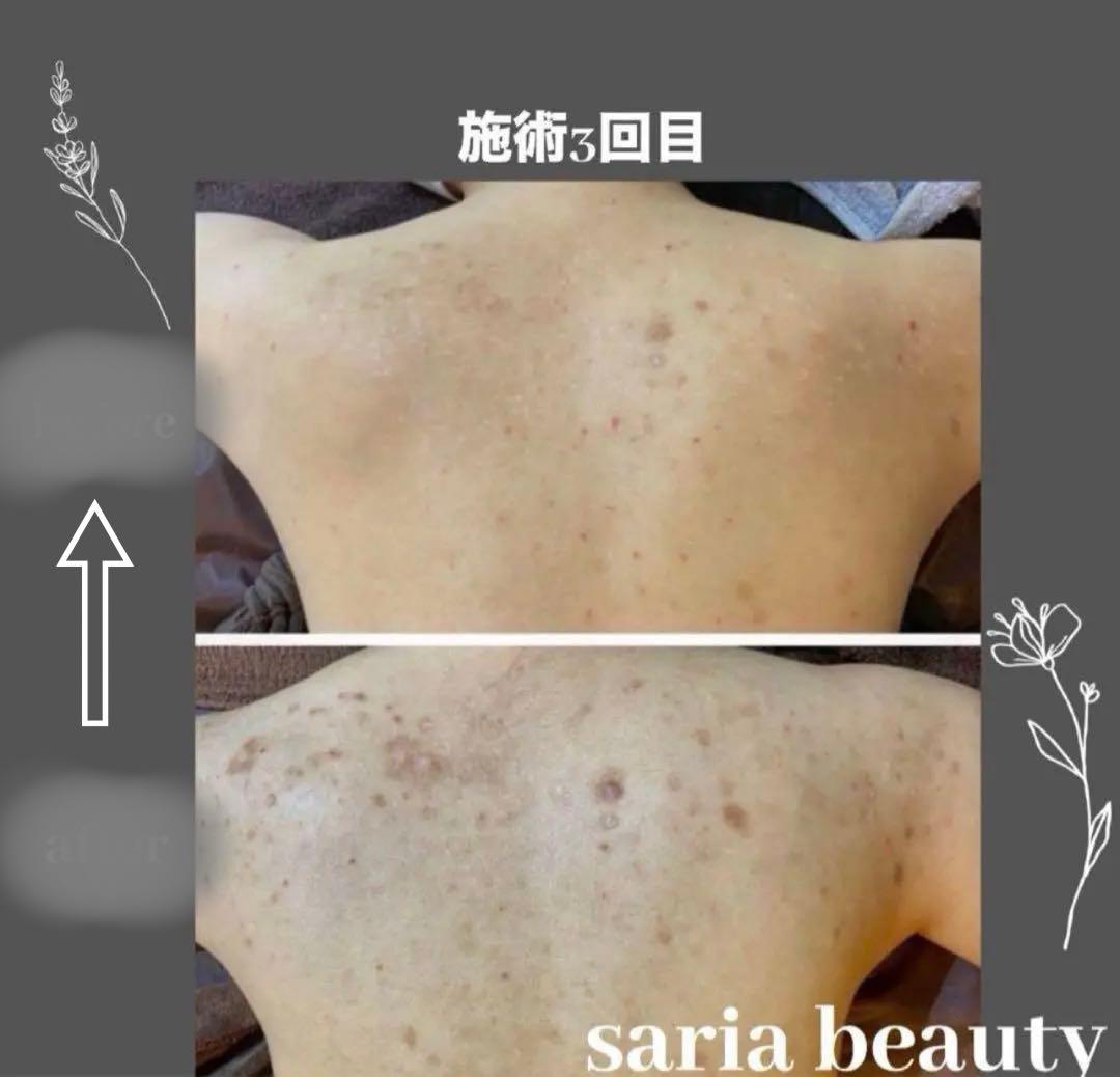 ハーブピーリング 剥離あり 漢方医薬所製造 医薬ハーブ 背中ニキビ対策