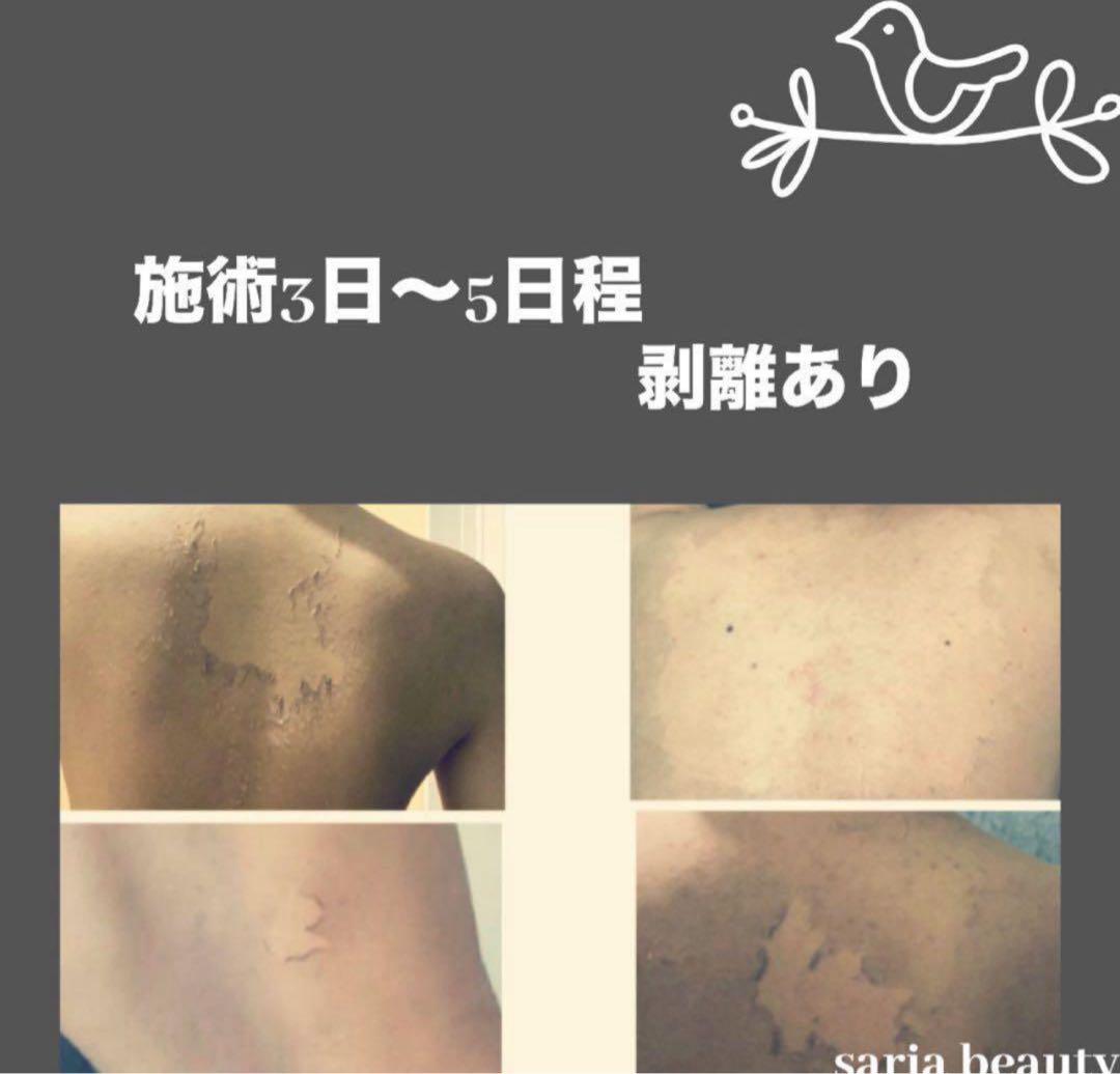 ハーブピーリング 剥離あり 漢方医薬所製造 医薬ハーブ 背中ニキビ対策