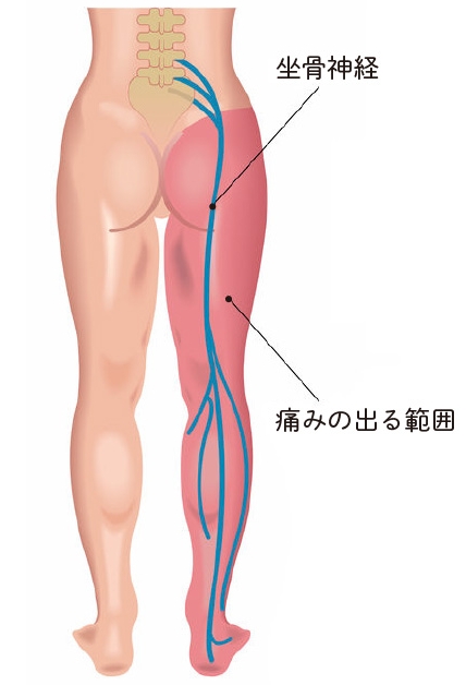 痛み・凝り・痺れる症状 | NAO鍼灸院